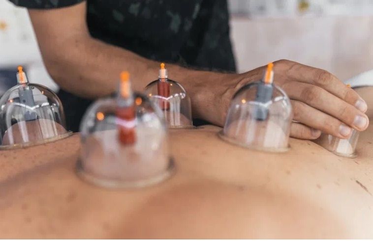 Cupping cups placed along a client&rsquo;s back